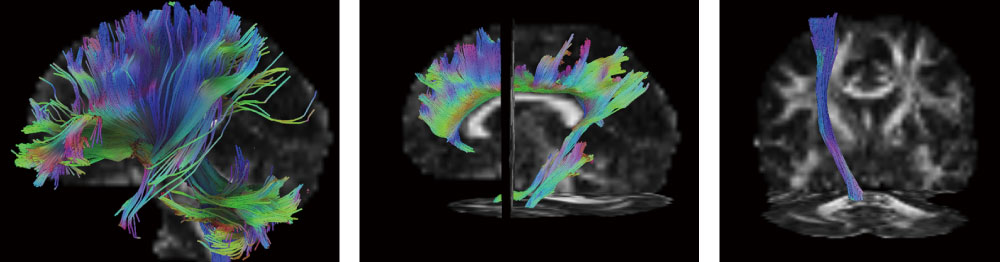 MRIを用いた神経線維評価とネットワーク解析